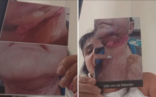 Laudo do IML confirma lesões graves em segunda paciente de dentista denunciada por complicações em procedimentos estéticos