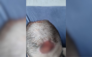Adolescente autista com ferida exposta na cabeça aguarda cirurgia há 19 dias no interior de SP